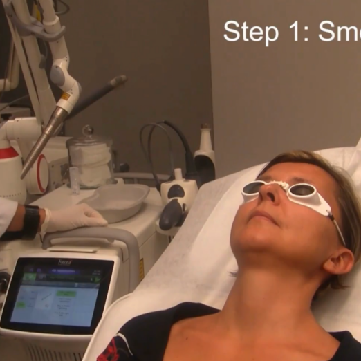 Ansiktsbehandling med 4D-laser