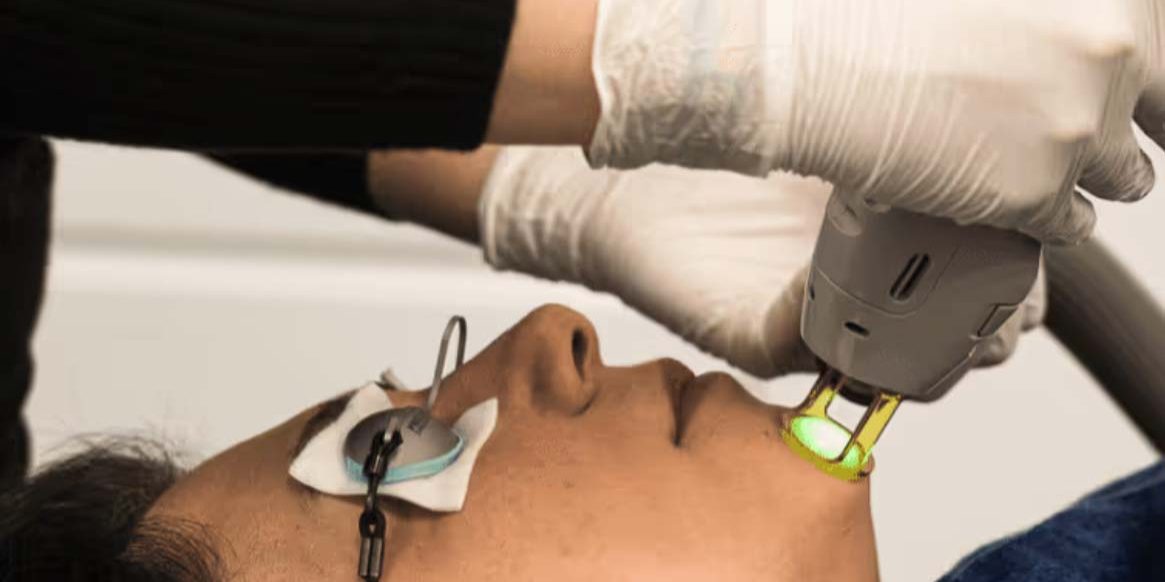 haarfjerning-med-laser