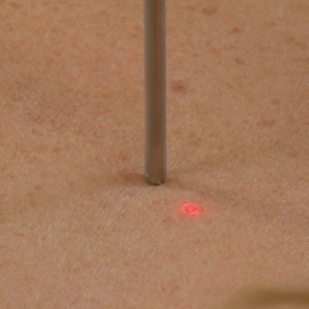 pigmentfjerning-med-laser